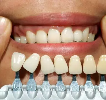 Diş Beyazlatma (Bleaching) Nedir? - Özel Coşkun Ağız ve Diş Sağlığı Polikliniği