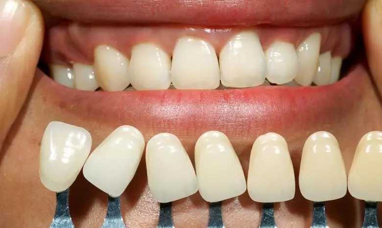 Diş Beyazlatma (Bleaching) Nedir? - Özel Coşkun Ağız ve Diş Sağlığı Polikliniği