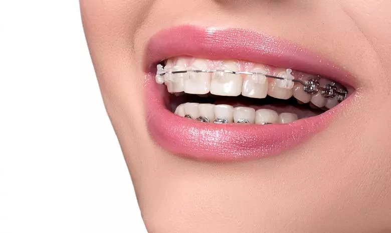 Diş Teli Tedavisi Nedir? - Özel Coşkun Ağız ve Diş Sağlığı Polikliniği