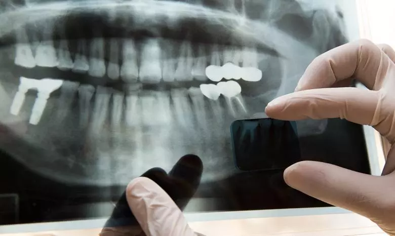 Kanal Tedavisi Nedir? - Özel Coşkun Ağız ve Diş Sağlığı Polikliniği