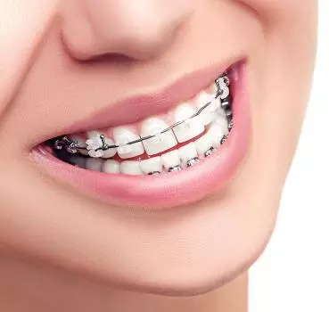 Ortodonti Tedavi Nedir? - Özel Coşkun Ağız ve Diş Sağlığı Polikliniği