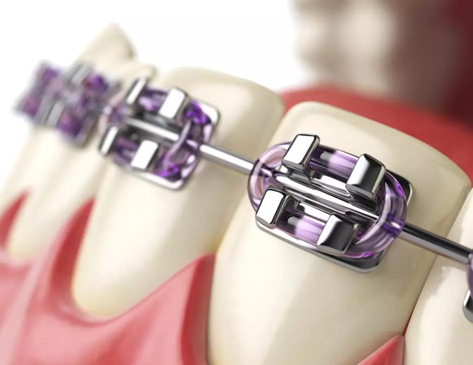 Ortodonti Tedavisi - Özel Coşkun Ağız ve Diş Sağlığı Polikliniği