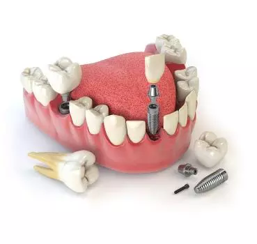 Dental İmplantlar - Özel Coşkun Ağız ve Diş Sağlığı Polikliniği