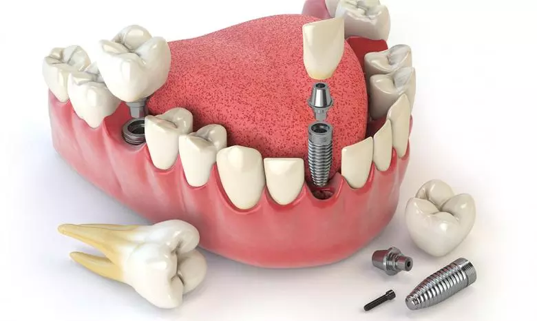 Dental İmplantlar - Özel Coşkun Ağız ve Diş Sağlığı Polikliniği