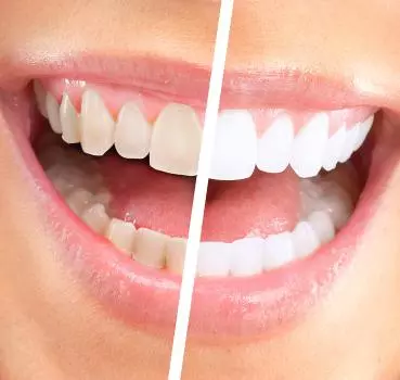 Diş Beyazlatma - Özel Coşkun Ağız ve Diş Sağlığı Polikliniği