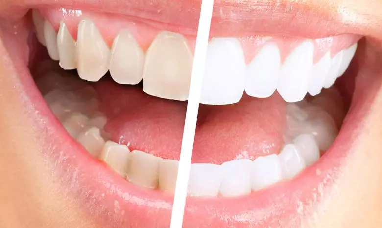 Diş Beyazlatma - Özel Coşkun Ağız ve Diş Sağlığı Polikliniği