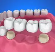 Porselen Kron ve Köprüler - Özel Coşkun Ağız ve Diş Sağlığı Polikliniği