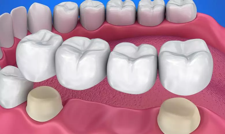 Porselen Kron ve Köprüler - Özel Coşkun Ağız ve Diş Sağlığı Polikliniği